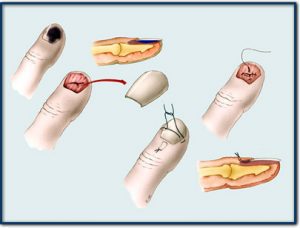 Sydney Hand Surgery Nail Bed Injuries | Sydney Hand Surgery